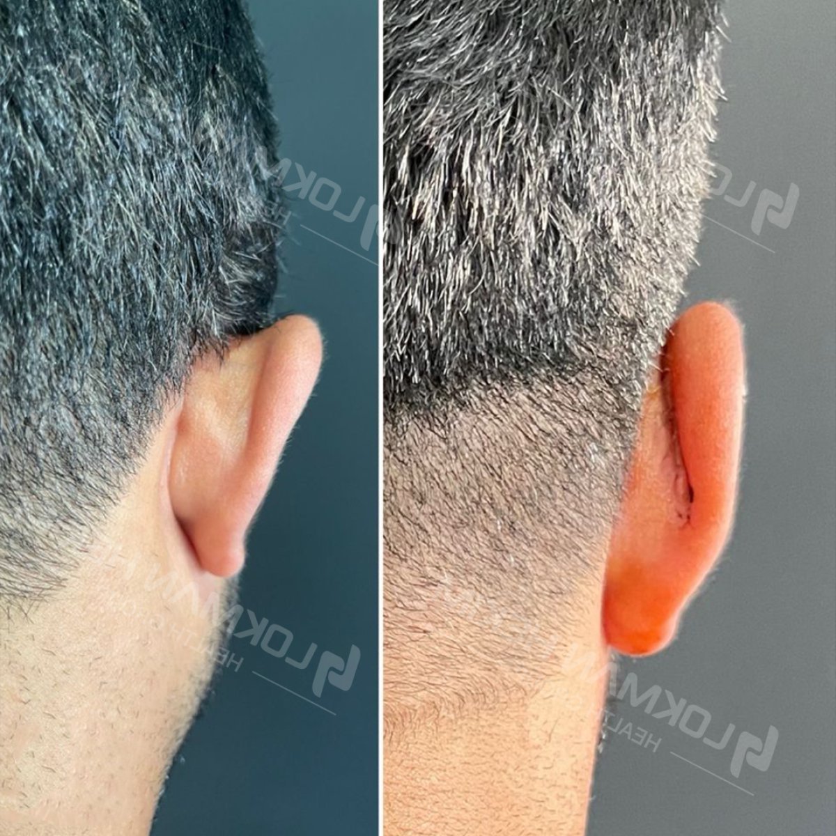Before and after otoplasty results at Lokman Hekim Istanbul Hospital, ear reshaping surgery