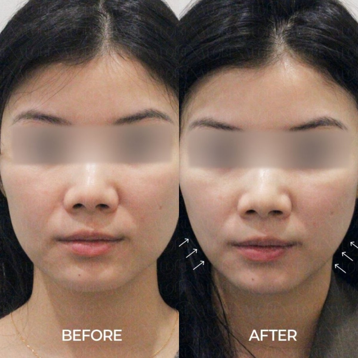 Before and after Ultherapy at Forena Clinic, visible facial skin tightening results