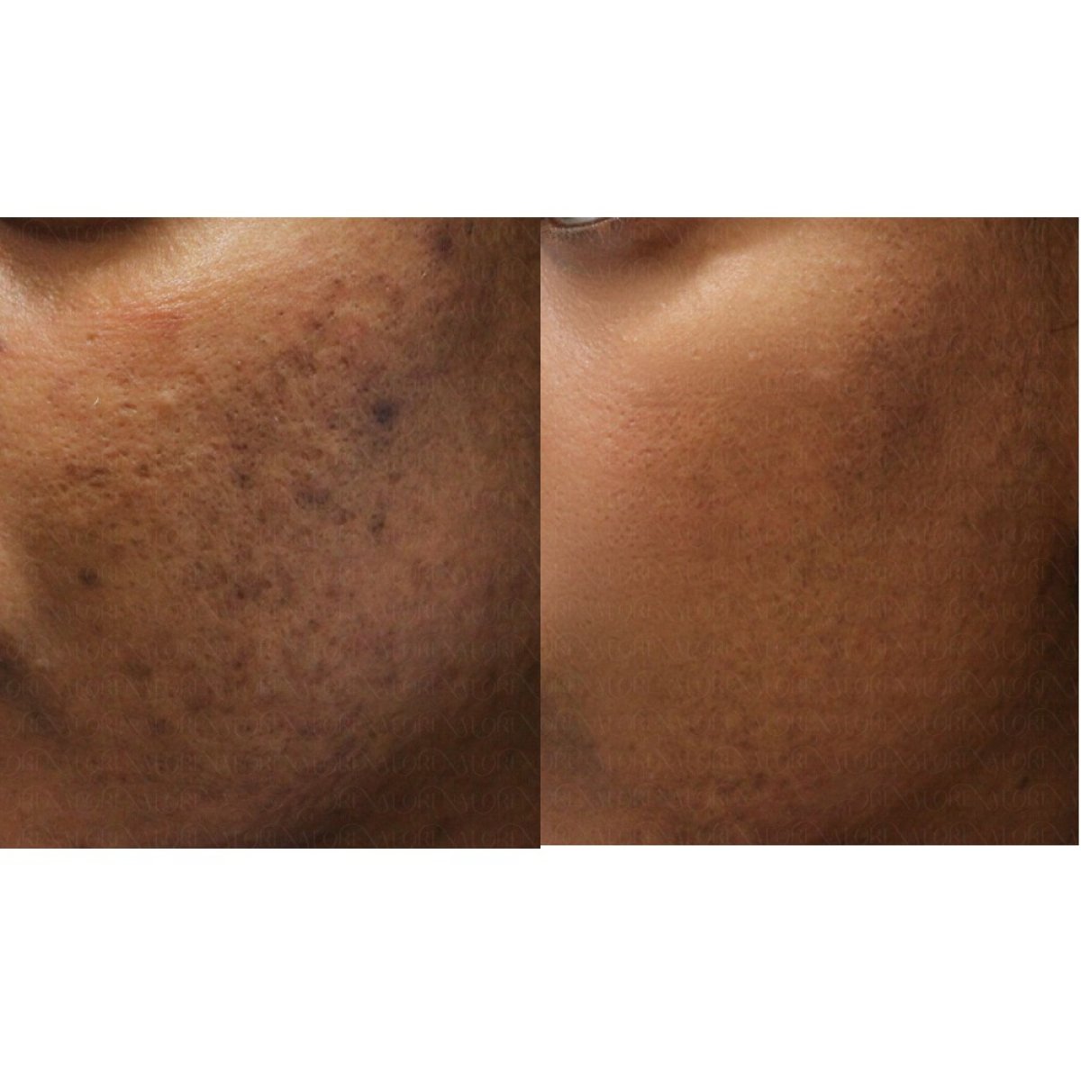 Before and after stem cell rejuvenation therapy results at Forena Clinic for smoother skin