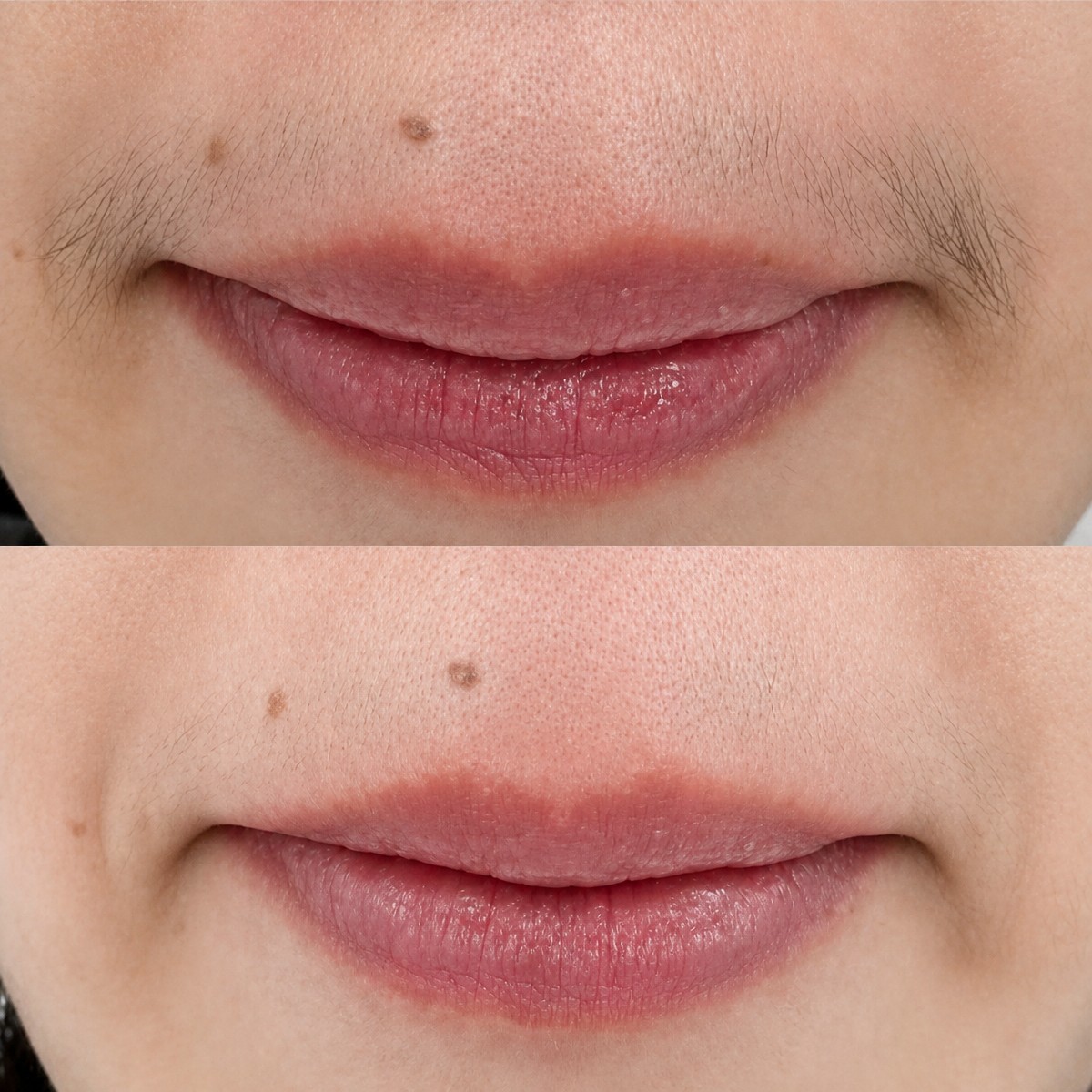 Before and after laser hair removal on upper lip at Wansiri Hospital, smooth skin result