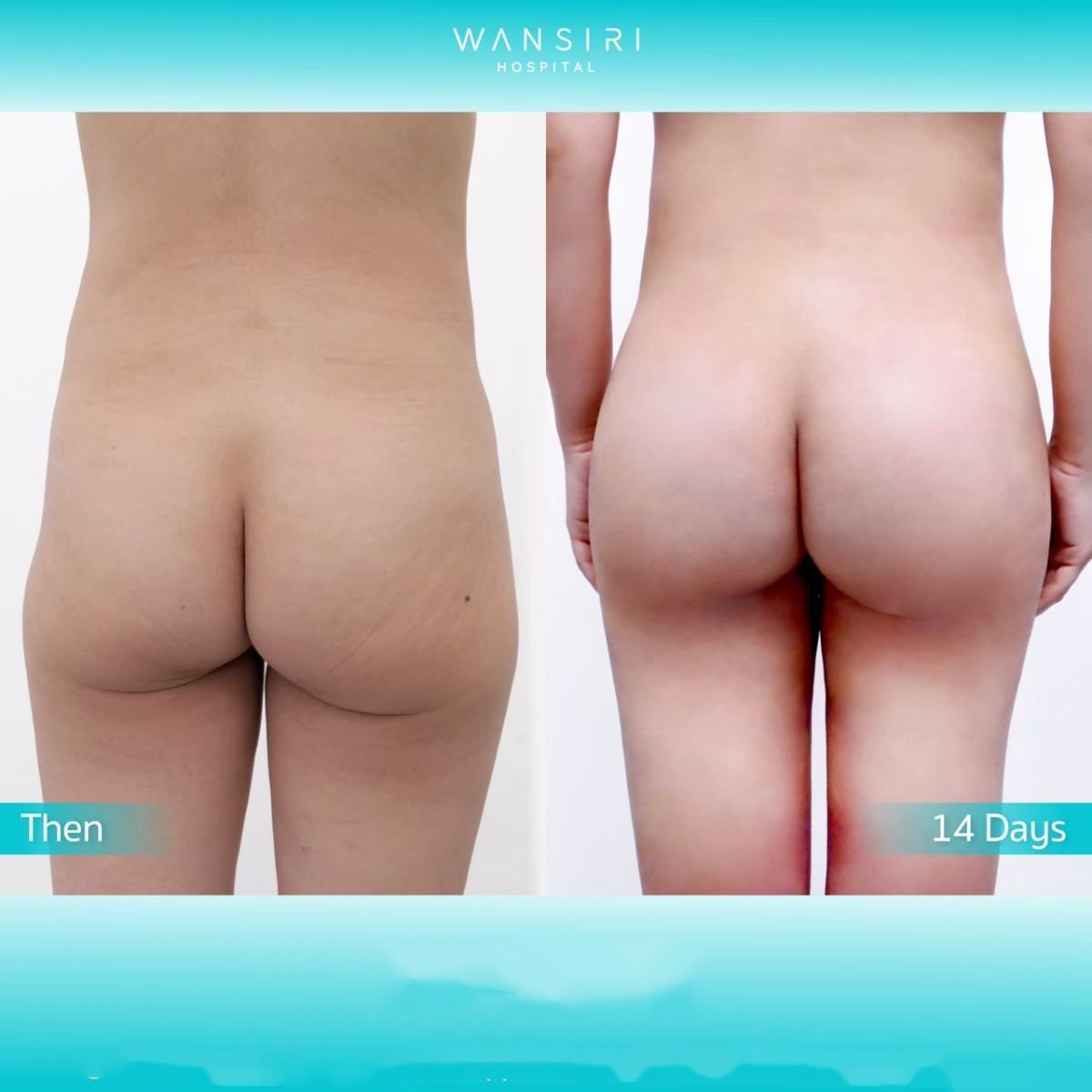 Avant et après implants fessiers à Wansiri Hospital, forme et volume améliorés