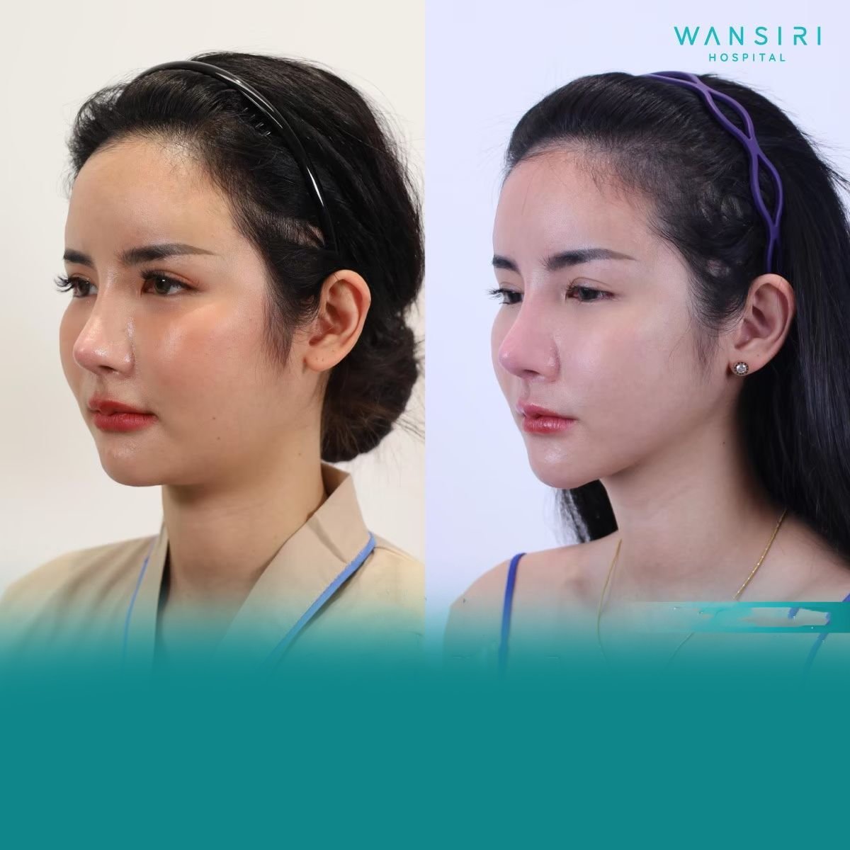 Resultados de rinoplastia antes y después en Wansiri Hospital, nariz de aspecto natural