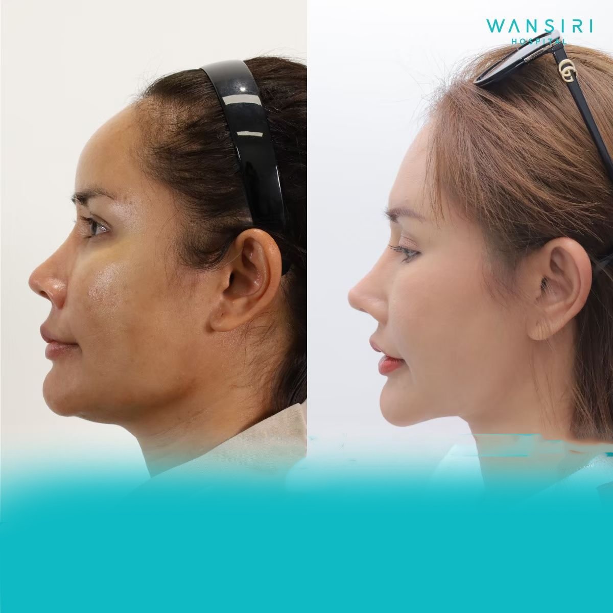 Before and after rhinoplasty results at Wansiri Hospital, nose reshaping with natural look
