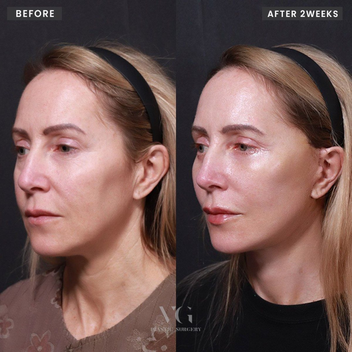 Facelift before and after results at VG Plastic Surgery – visible facial rejuvenation after 2 weeks
