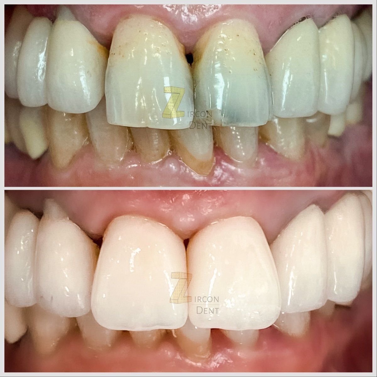 قبل وبعد تركيب تيجان الأسنان في Smile Centrum، نتيجة واضحة لاستعادة الابتسامة