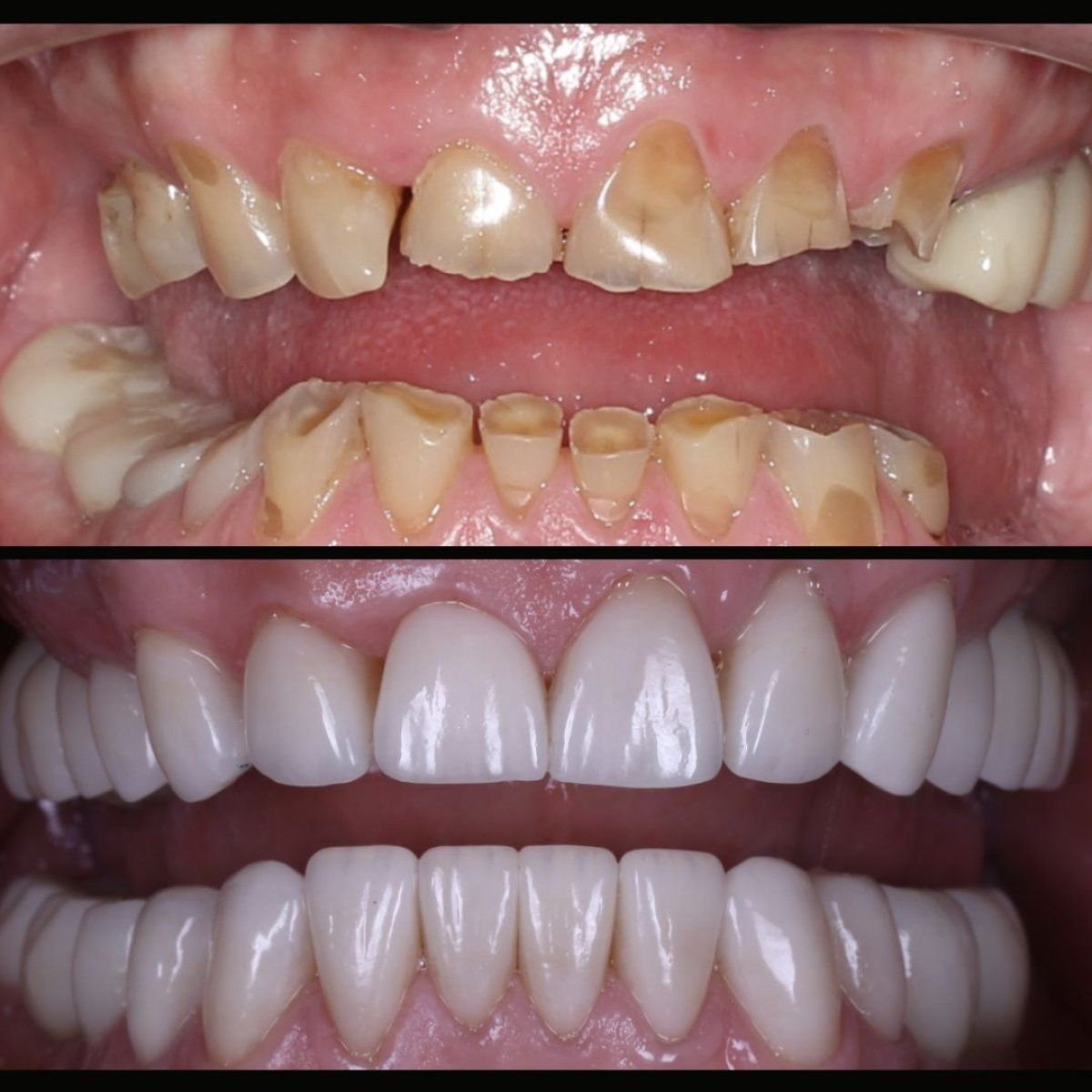 Résultat avant/après pose de couronnes dentaires chez Smile Centrum – dents restaurées