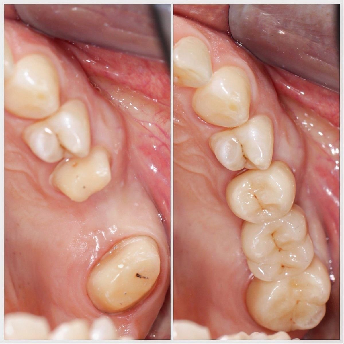 نتيجة قبل وبعد تركيب تاج معدني خزفي مدعوم بالزرع في عيادة Smile Centrum