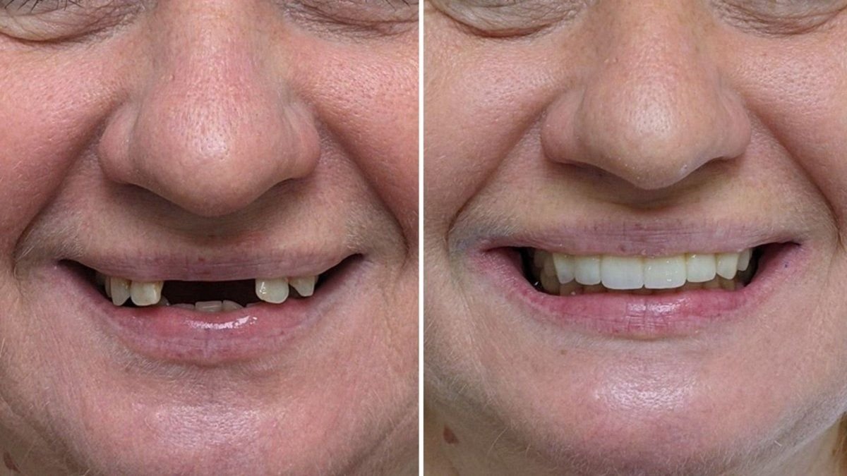 Resultado antes y después de implantes dentales All-on-6 en Smile Centrum – sonrisa restaurada
