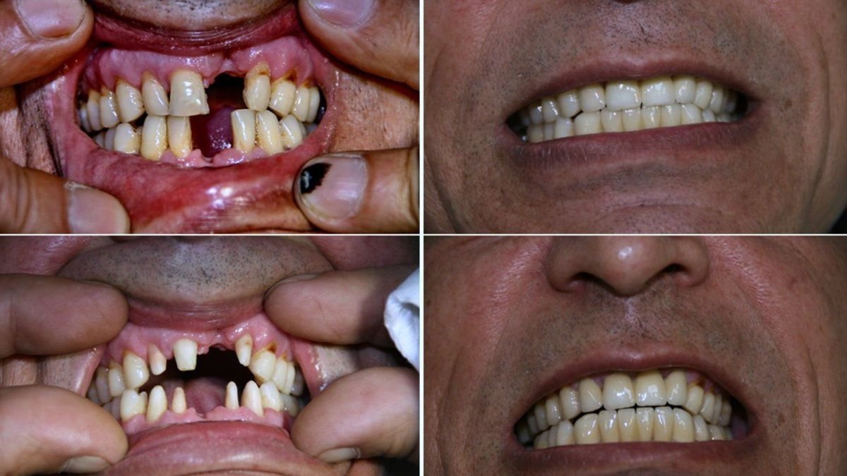 Resultados antes y después de implantes dentales All-on-6 en Smile Centrum, sonrisa restaurada
