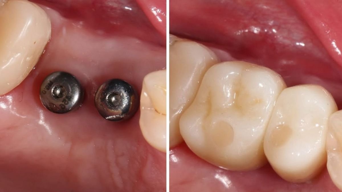 نتائج قبل وبعد تركيب تيجان الأسنان في Smile Centrum، استعادة وظيفة المضغ
