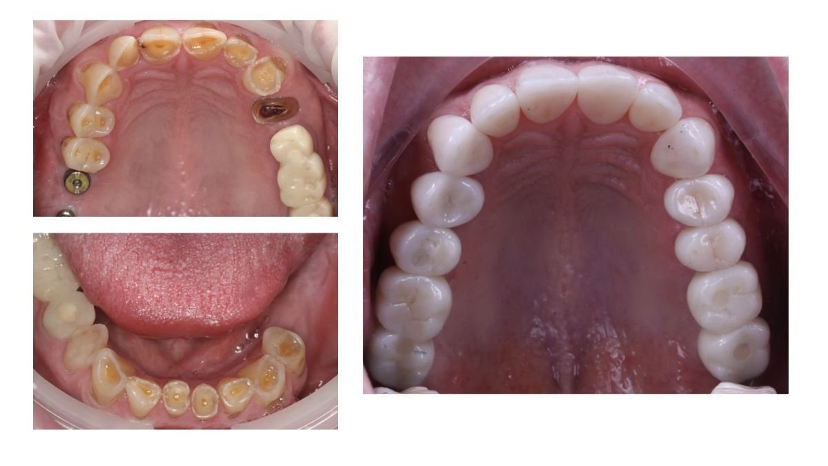 نتائج قبل وبعد تركيب تيجان الأسنان في Smile Centrum، مظهر أسنان محسّن