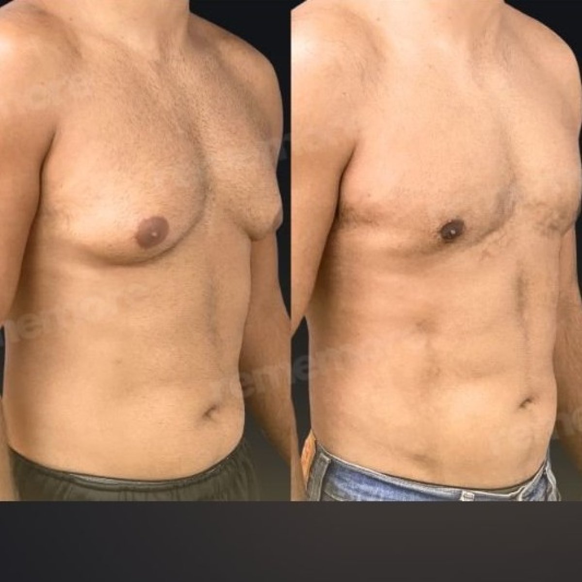 Résultats avant/après Vaser liposuccion Memorial Bahçelievler Hospital, torse masculin