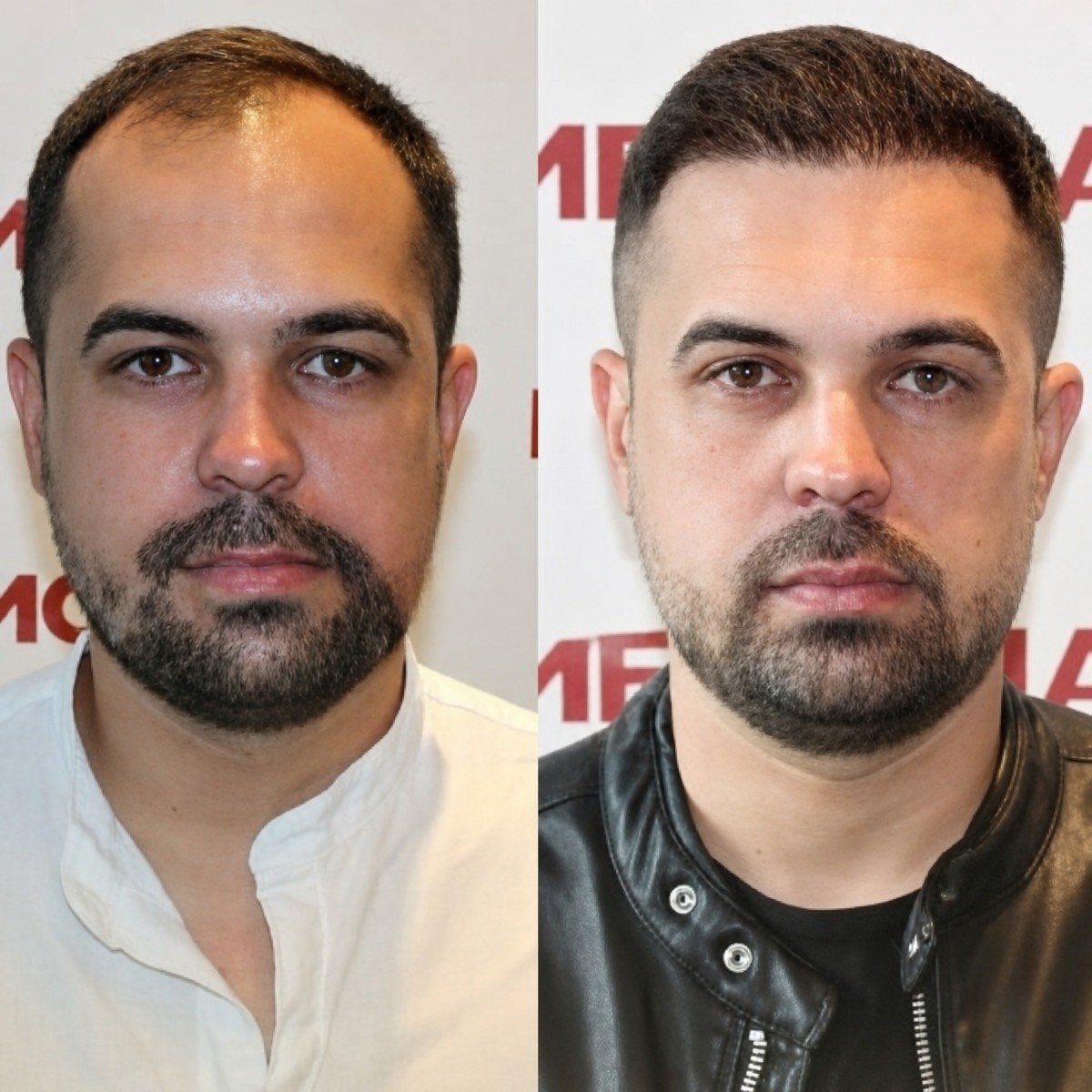 Before and after hair transplant results at Memorial Antalya Hospital, restored hairline in male
