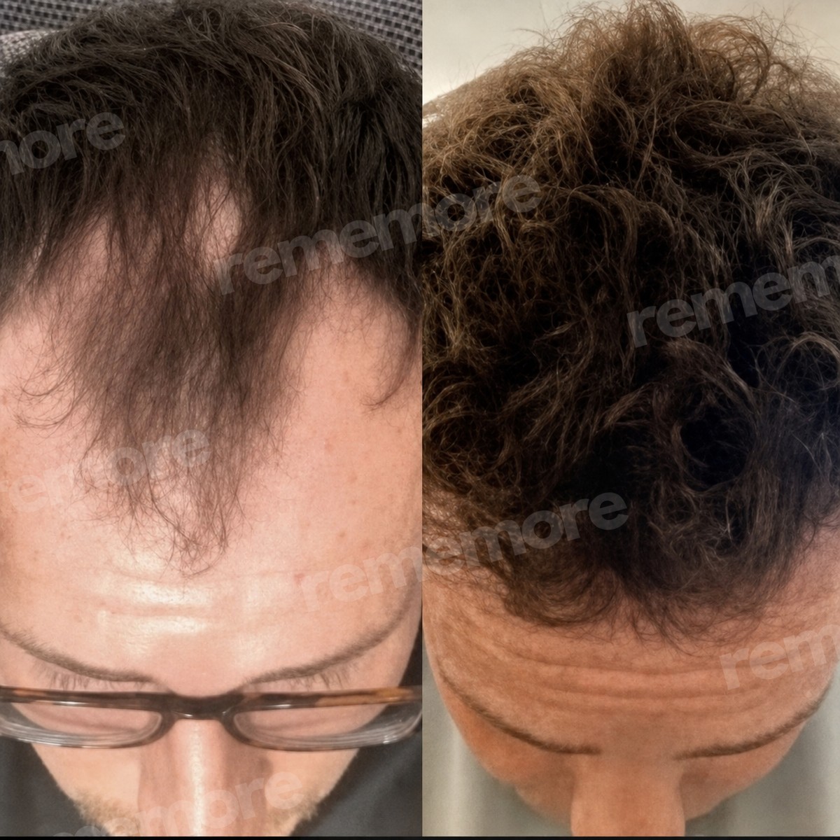 Resultados de trasplante capilar antes y después en Memorial Antalya Hospital, densidad restaurada
