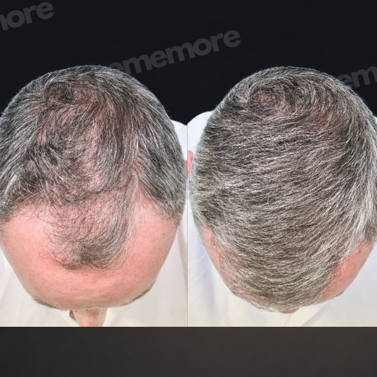Résultats greffe de cheveux avant/après à Memorial Antalya Hospital, densité améliorée