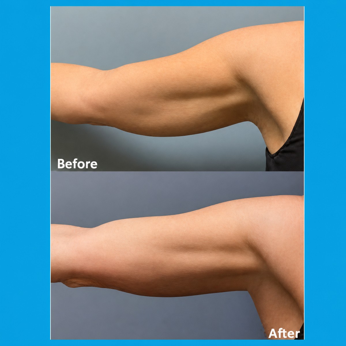 Before and after Morpheus8 skin tightening results on arms at ID Clinic Bangkok
