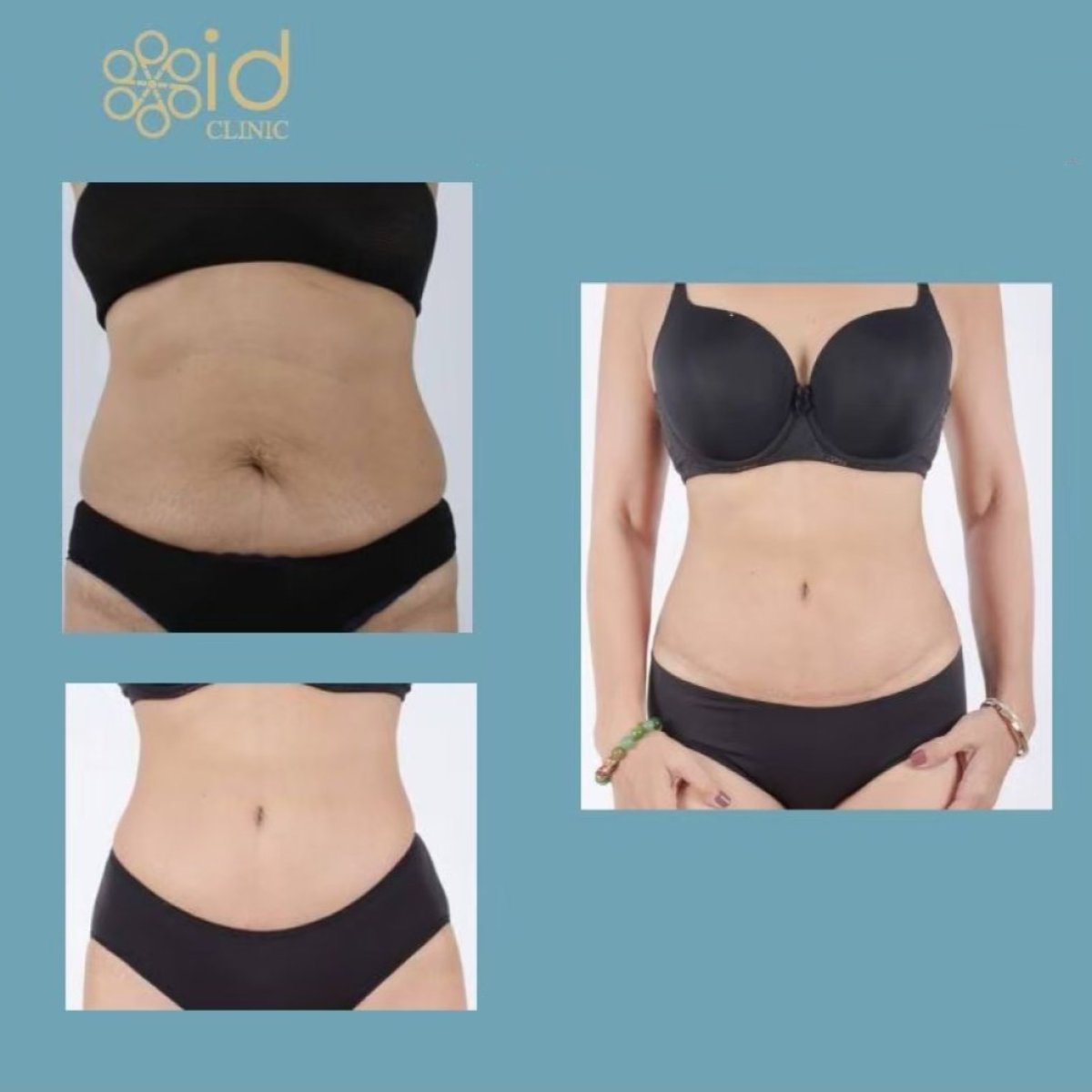 Before and after tummy tuck results at ID Clinic Bangkok showing improved abdominal contour