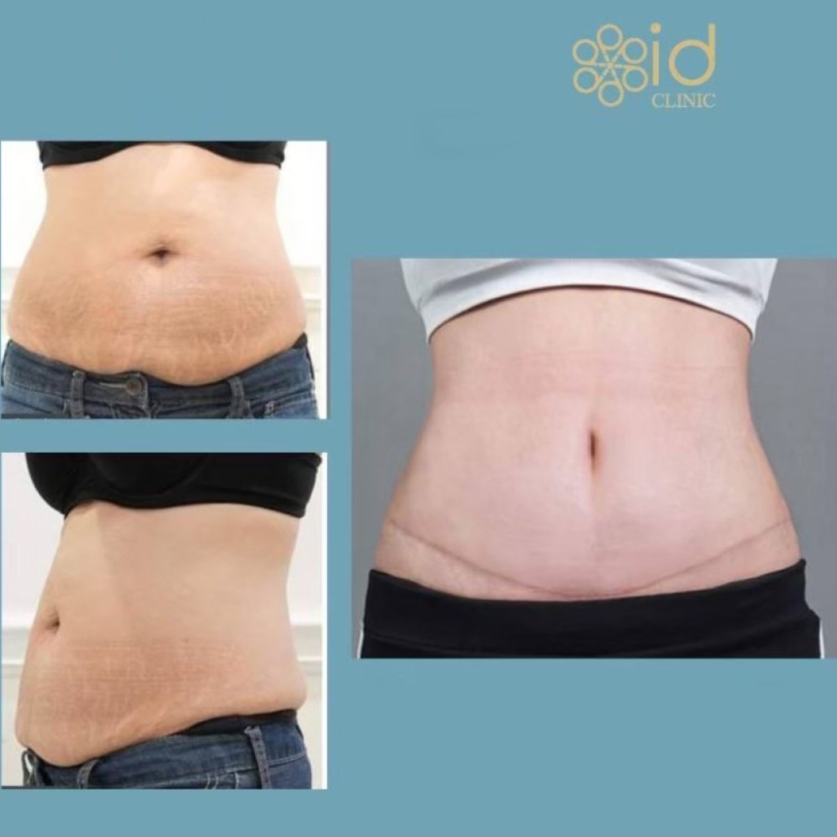 Before and after tummy tuck results at ID Clinic Bangkok – flatter, contoured abdomen