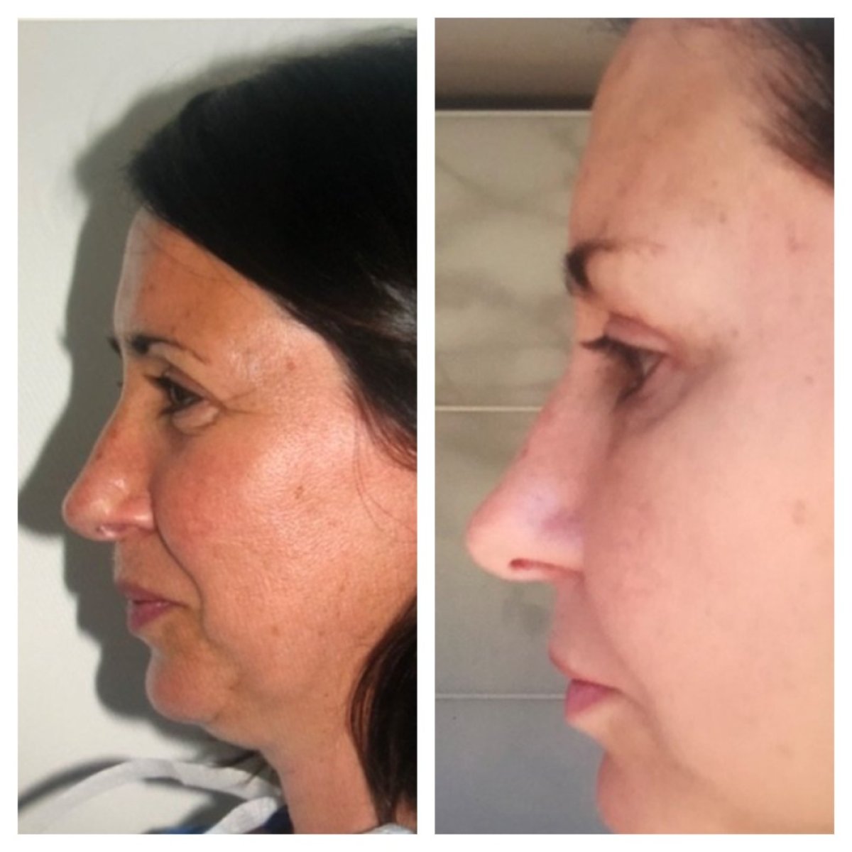 Antes y después de lipofilling facial en Clinica Granado Tiagonce, resultado visible del contorno