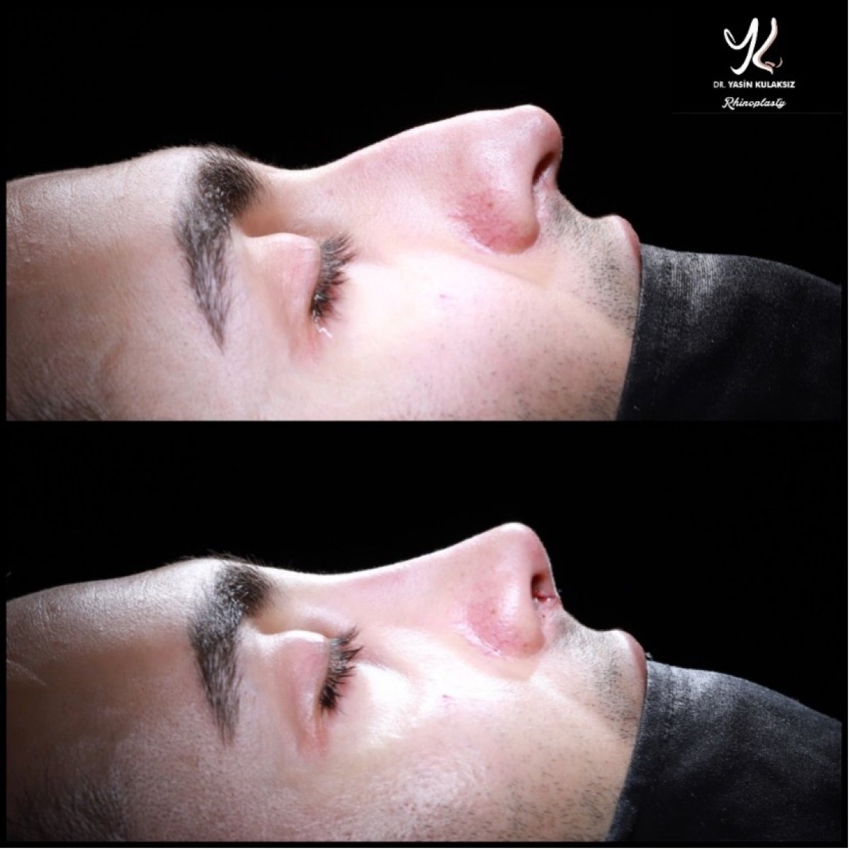 نتائج تجميل الأنف قبل وبعد في مستشفى ميديبول أكيبديم، تحسين شكل الأنف