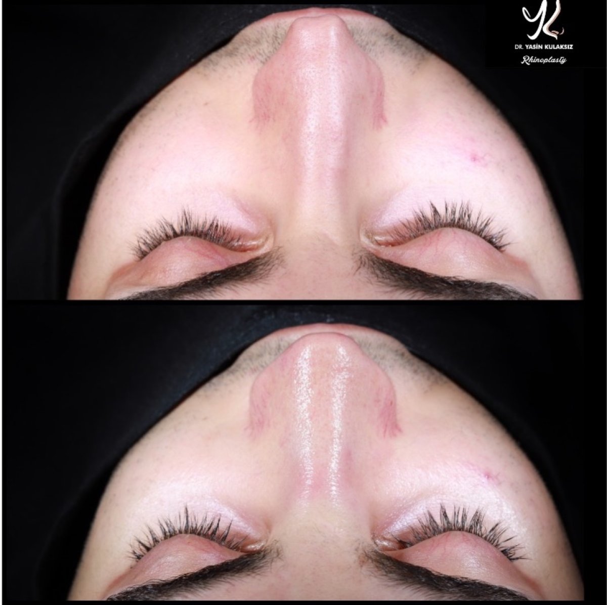 Resultados de rinoplastia antes y después en Medipol Acibadem District Hospital, remodelación nasal