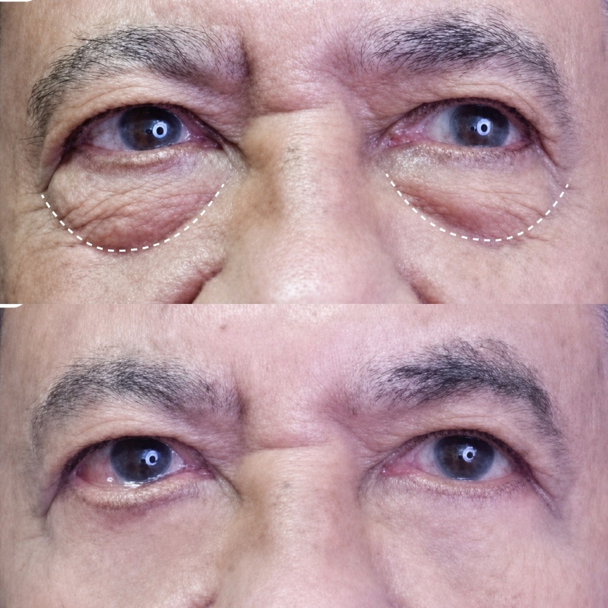 Before and after upper and lower eyelid surgery results at Asia Cosmetic Hospital