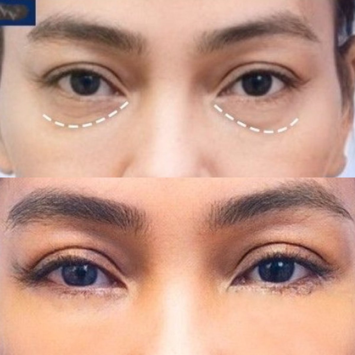 Before and after upper and lower eyelid surgery results at Asia Cosmetic Hospital