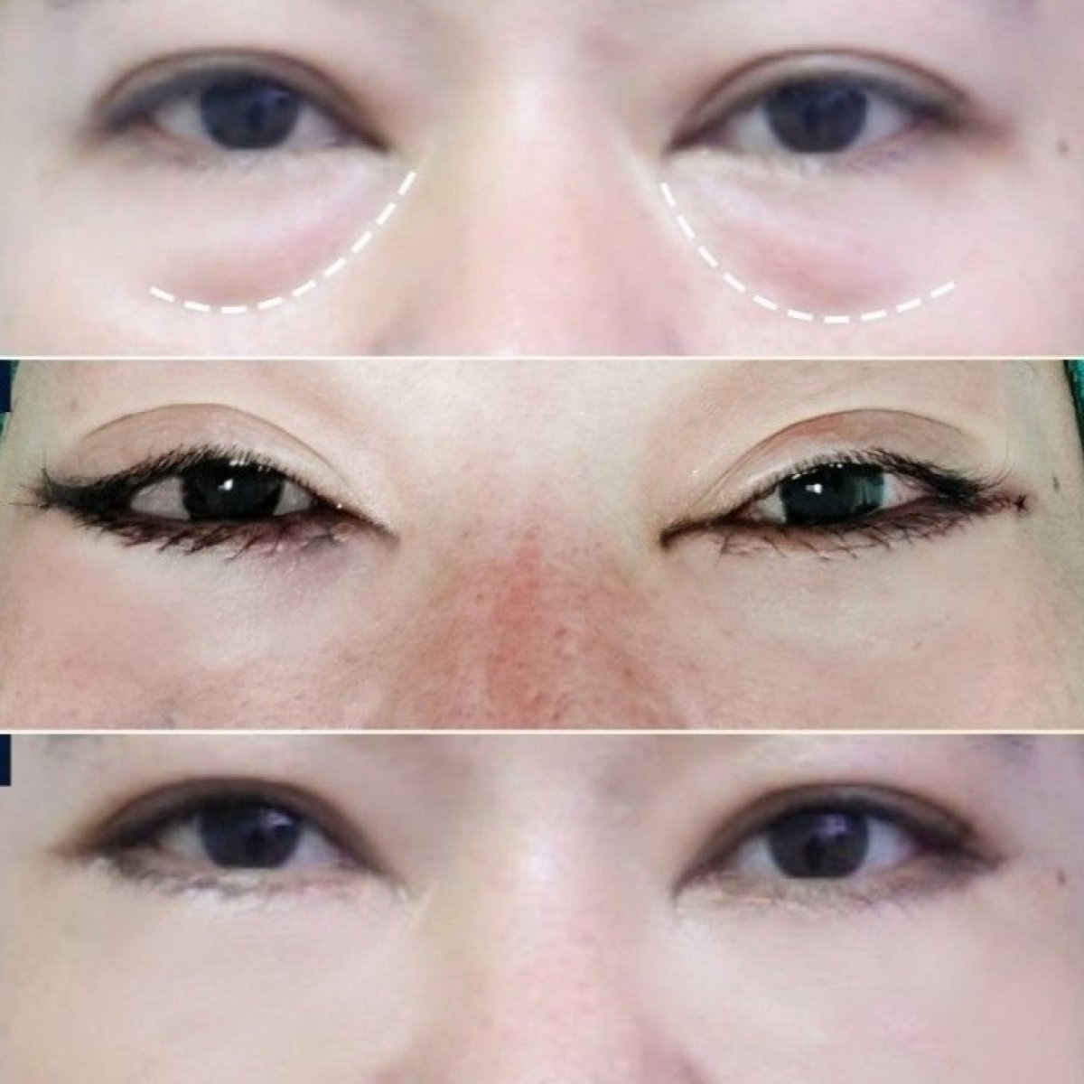 Upper and lower eyelid surgery before and after results at Asia Cosmetic Hospital, rejuvenated look
