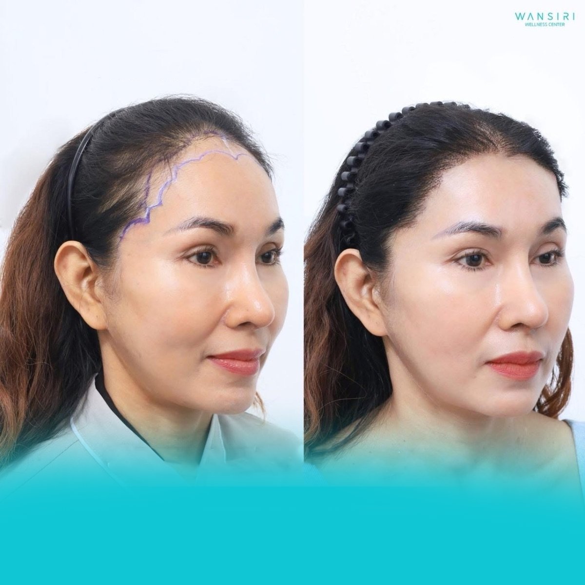 Before and after PRP hair loss treatment results at Wansiri Hospital, improved hairline density