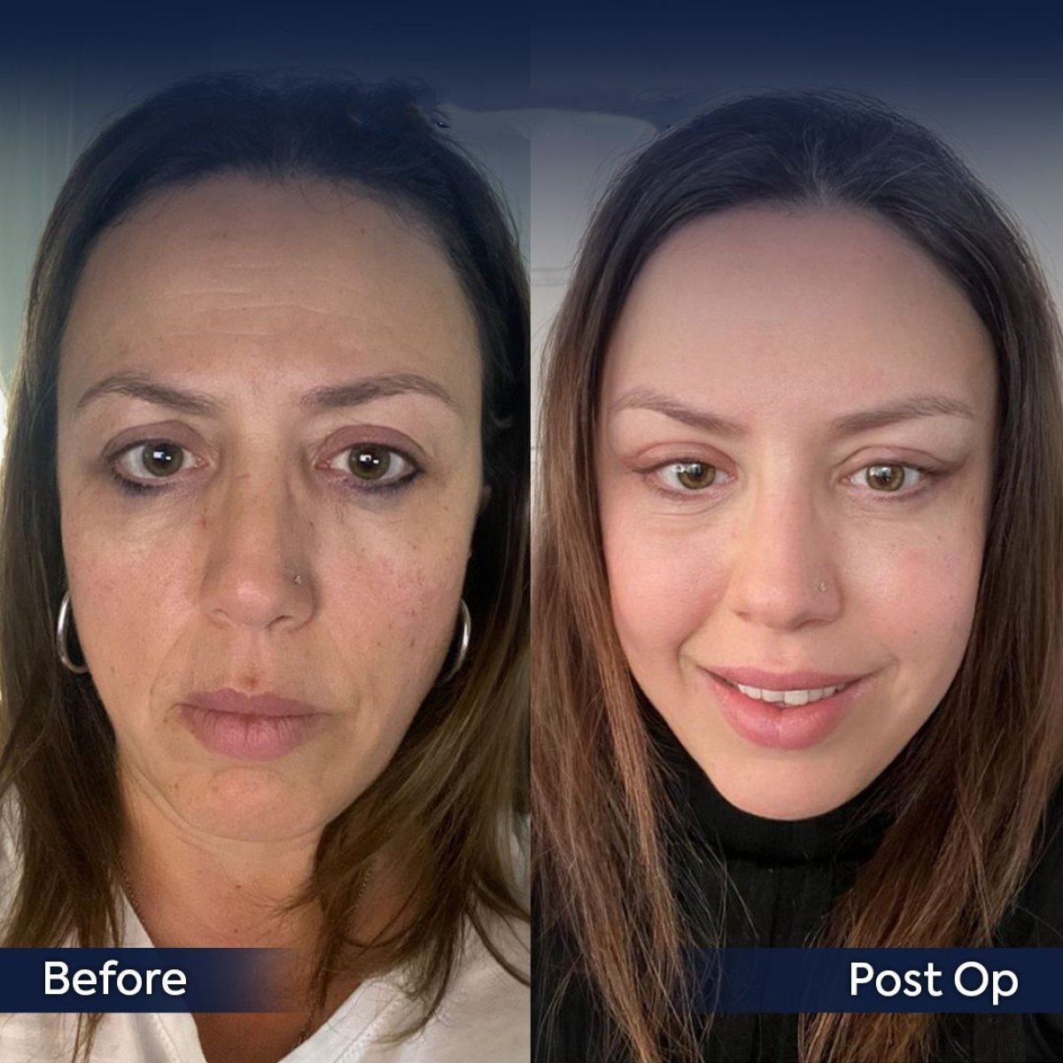 Resultados de lifting endoscópico facial antes y después en Dr. Safa Manav Clinic