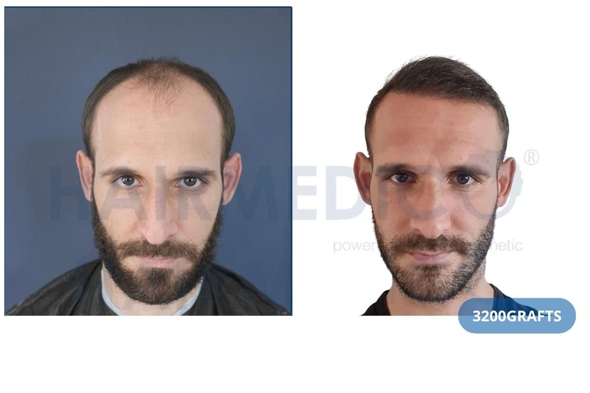 نتيجة زراعة الشعر في Hairmedico Clinic قبل وبعد، 3200 طعم لخط شعر أكثر كثافة