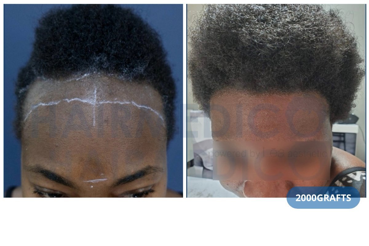 نتيجة زراعة الشعر في عيادة Hairmedico مع 2000 طعم لخط الشعر الأمامي