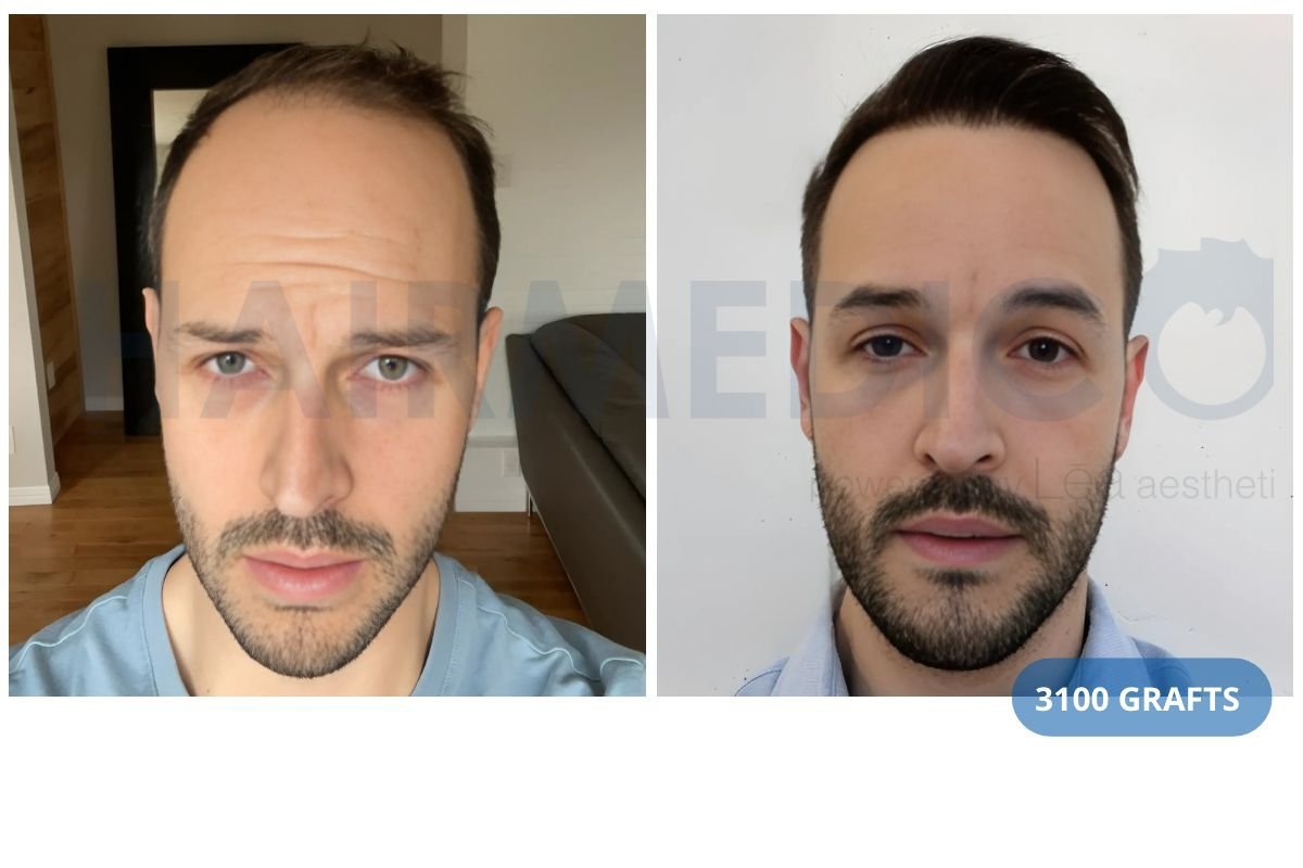 Before and after 3100 grafts hair transplant result at Hairmedico Clinic, restored hairline