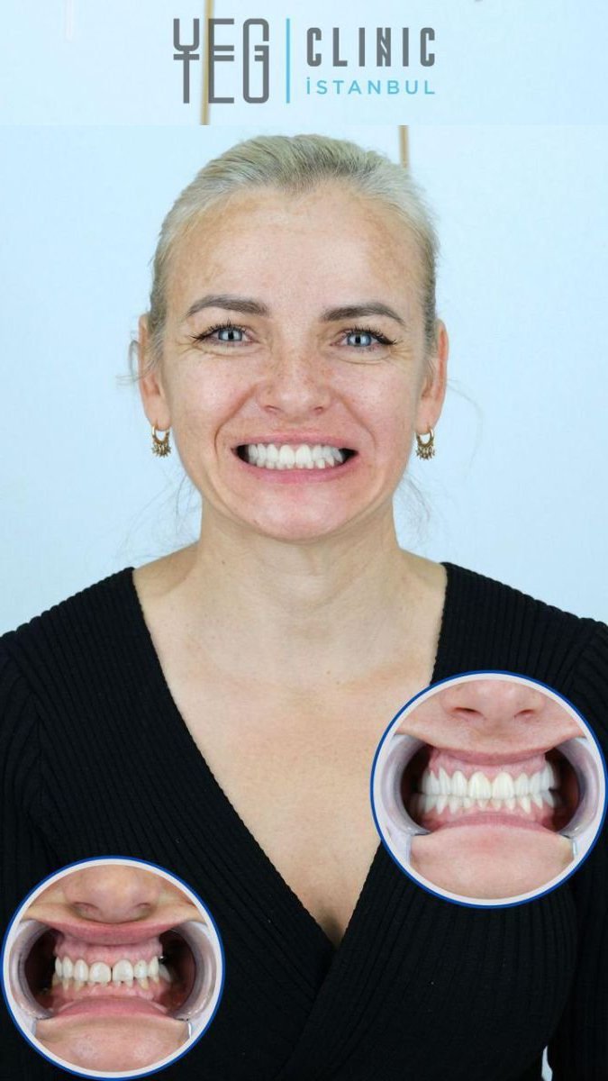 Resultado antes y después de implantes dentales All-on-6 en YEG Clinic, sonrisa mejorada