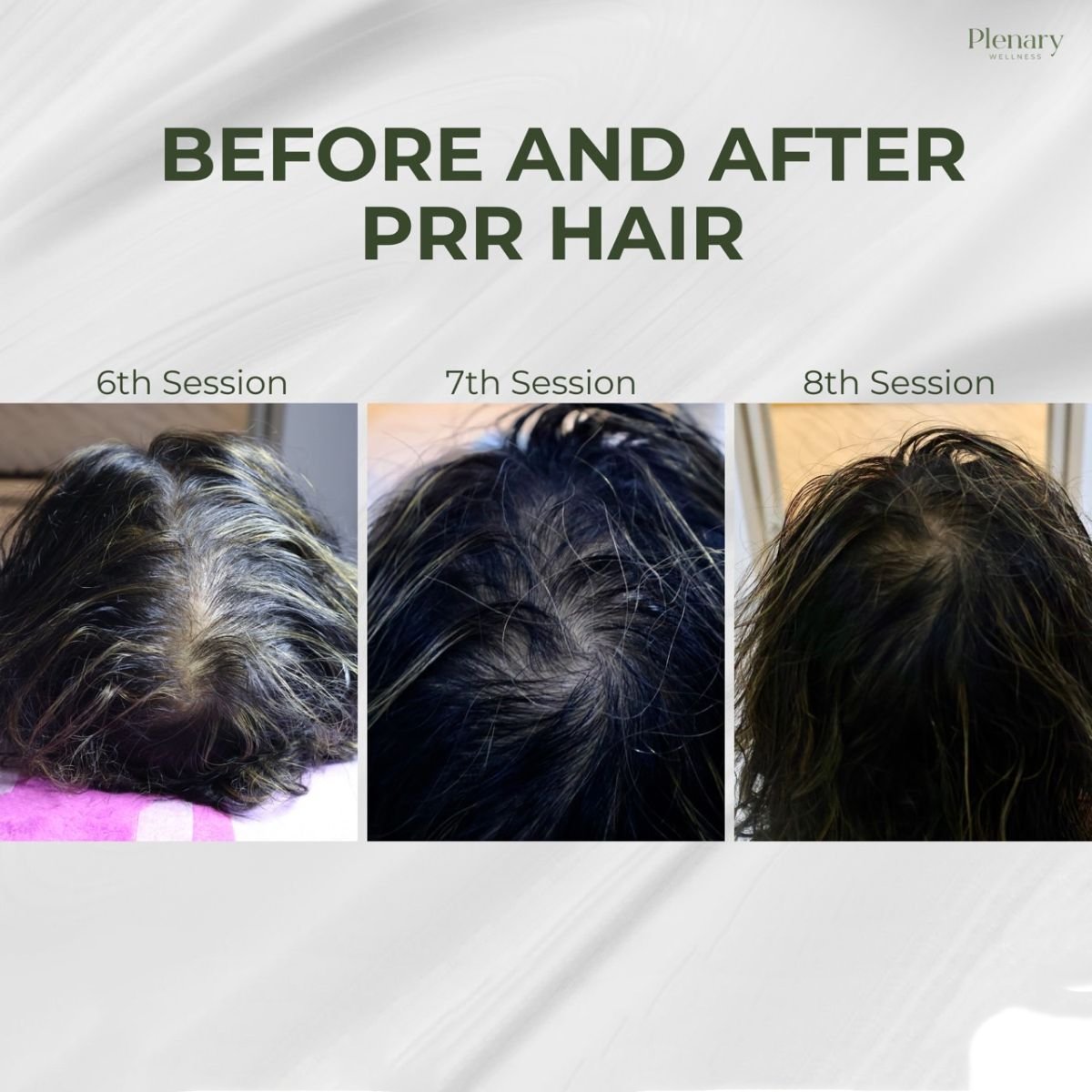 نتائج علاج تساقط الشعر PRP في Plenary Wellness – تحسن كثافة الشعر بعد الجلسات