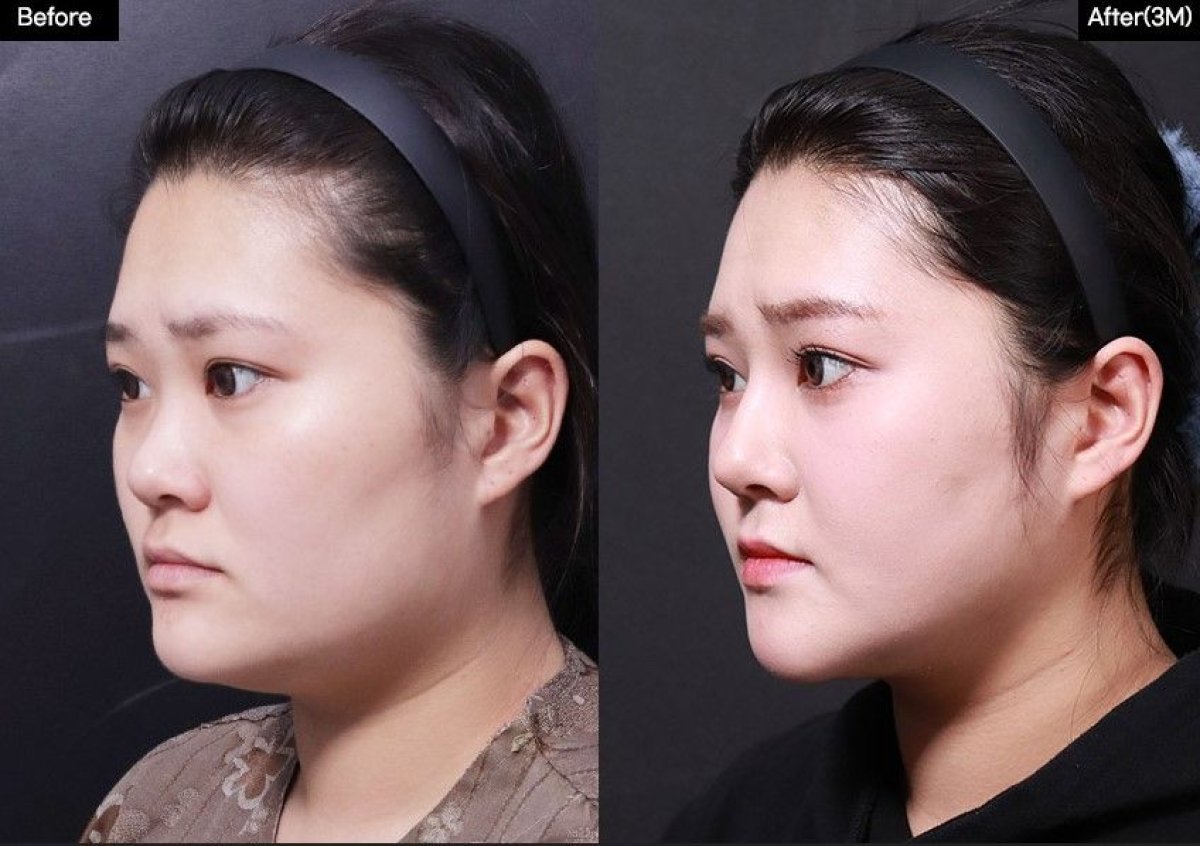 Before and after cheek implants at VG Plastic Surgery, enhanced cheek contour visible result