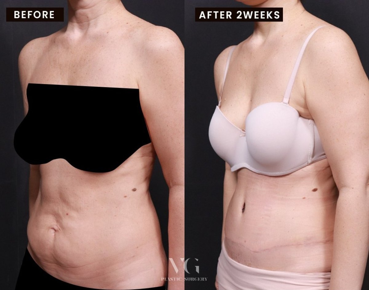 Результати абдомінопластики у VG Plastic Surgery – плаский живіт через 2 тижні