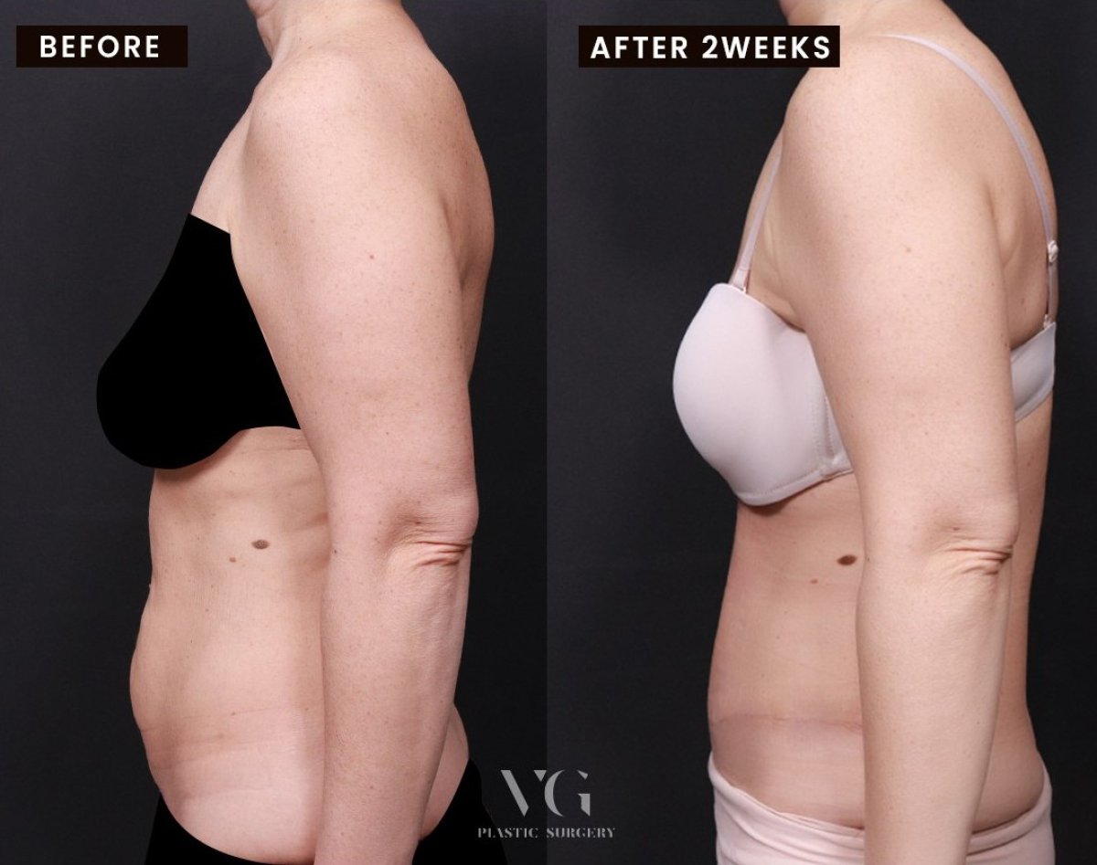Efekty przed i po plastyce brzucha w VG Plastic Surgery, poprawa konturu brzucha