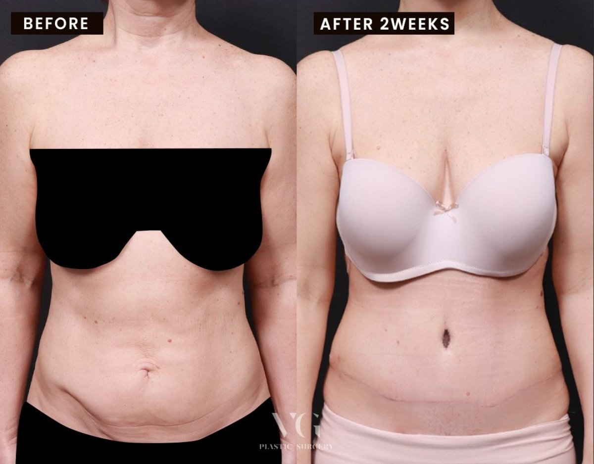 نتائج شد البطن قبل وبعد في VG Plastic Surgery – بطن مسطح بعد أسبوعين