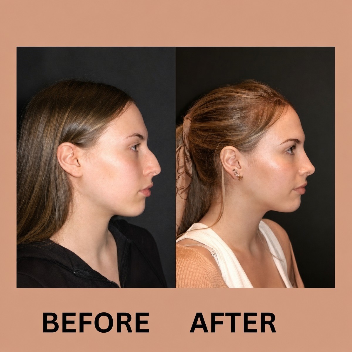 Before and after rhinoplasty results at ID Clinic Bangkok, nose reshaping for improved profile