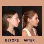 صور قبل وبعد جراحة الأنف (انظر عملية تجميل الأنف) للدكتور Dr Phatcharasak Kraisornphongsakul Md