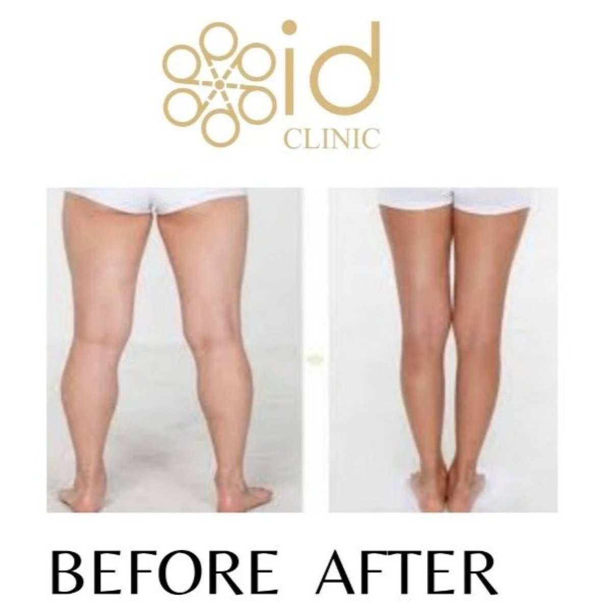 Before and after calf liposuction results at ID Clinic Bangkok, slimmer leg contour visible
