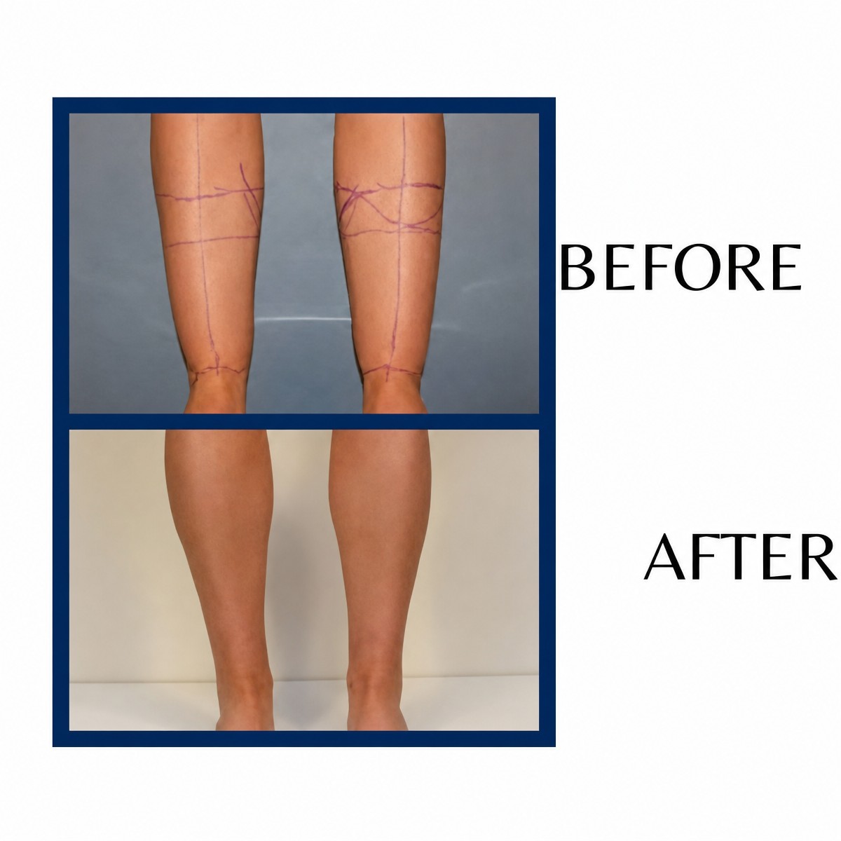 Before and after calf liposuction results at ID Clinic Bangkok, slimmer leg contour achieved