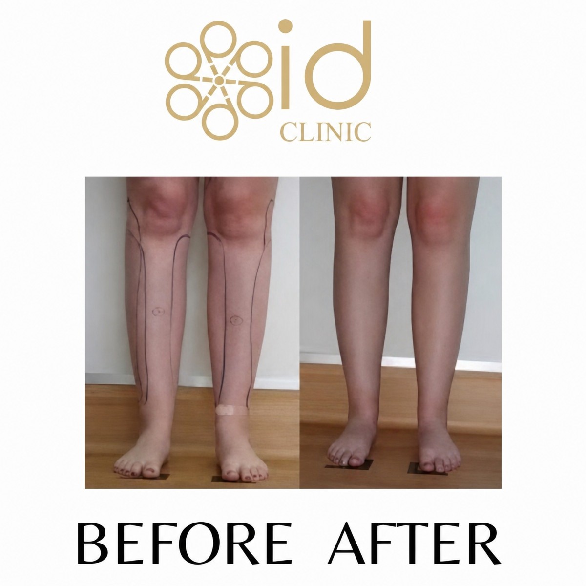 Before and after calf liposuction results at ID Clinic Bangkok – slimmer, contoured legs