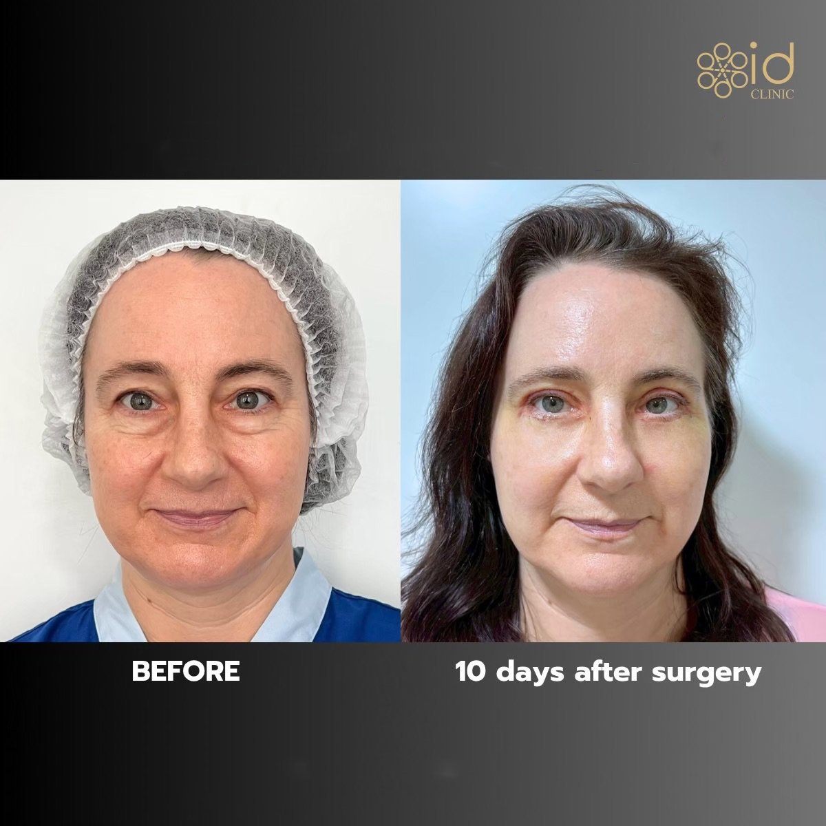 Before and after chin liposuction results at ID Clinic Bangkok, visible contour improvement