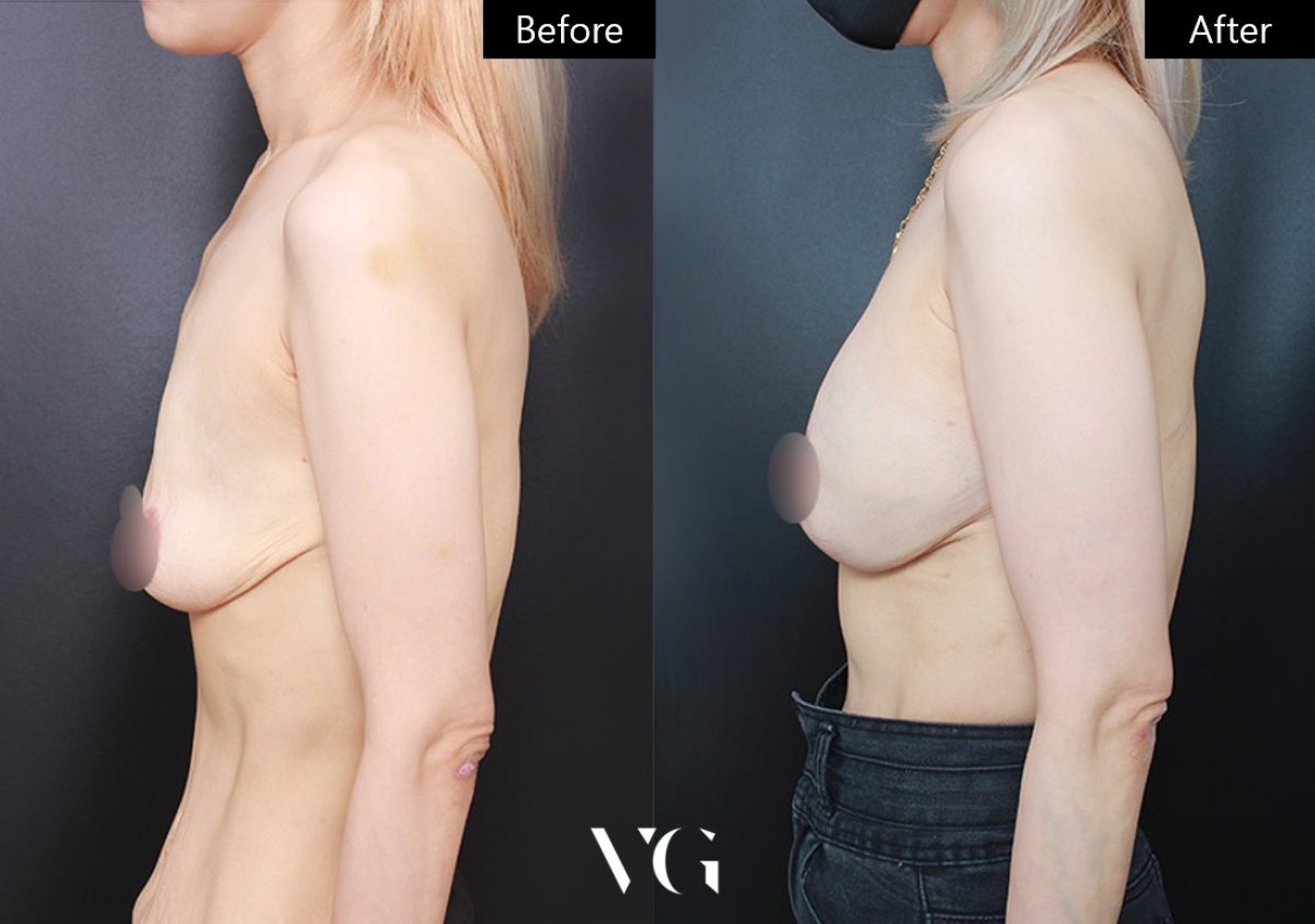 Результаты до и после подтяжки груди в VG Plastic Surgery – улучшенный контур груди