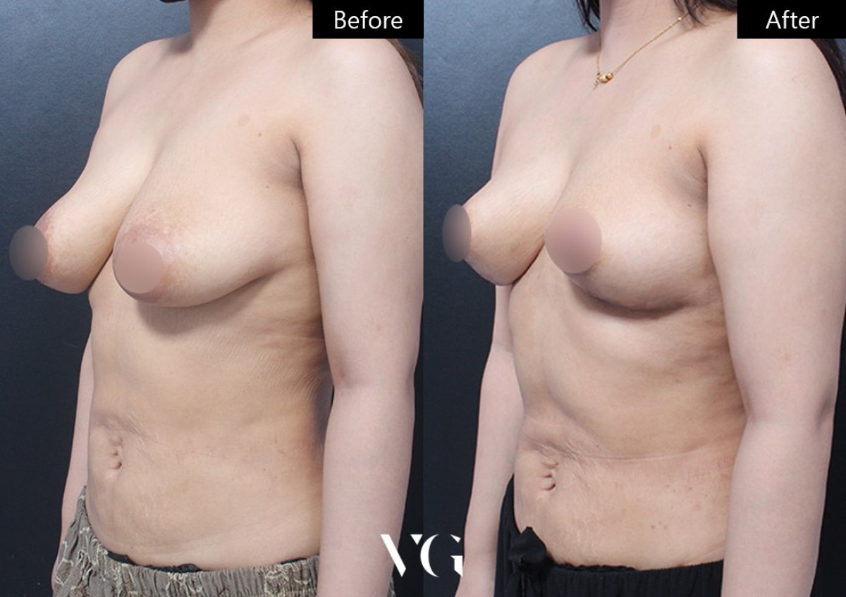 Результаты до и после подтяжки груди в VG Plastic Surgery, улучшение контура груди