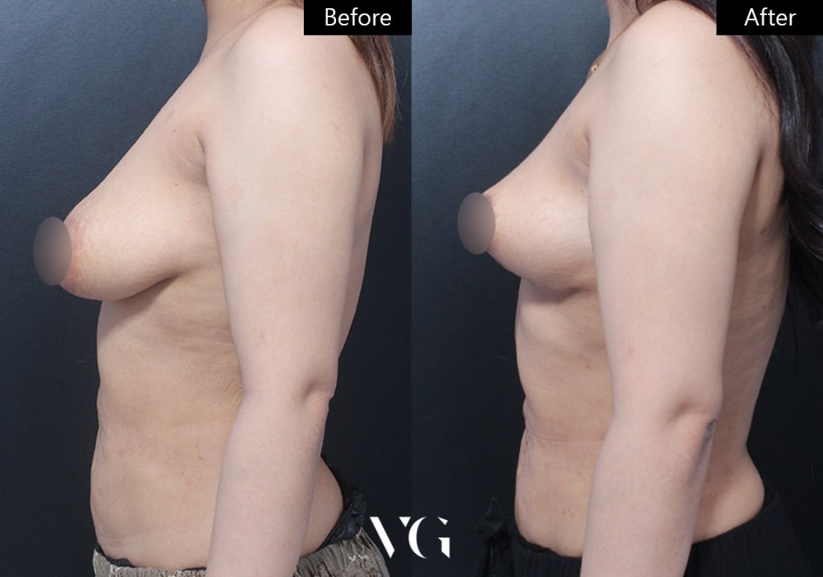 Before and after breast lift results at VG Plastic Surgery – improved breast contour