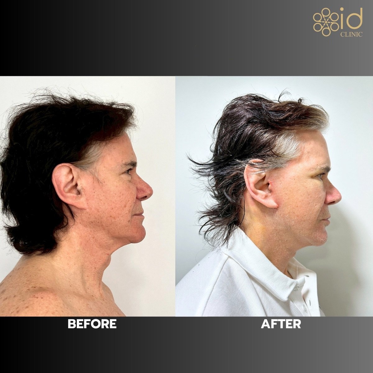 Before and after deep plane facelift results at ID Clinic Bangkok, visible facial rejuvenation