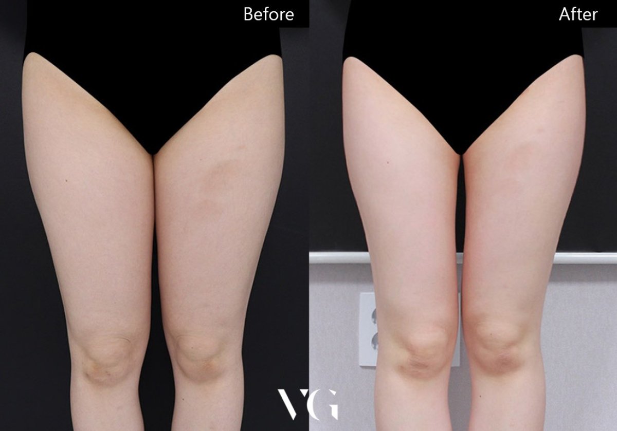 Результаты липосакции до и после в VG Plastic Surgery: стройные бедра, улучшенный контур